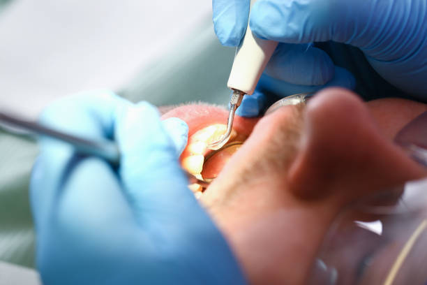 Best Emergency Tooth Extraction in Mauldin, SC