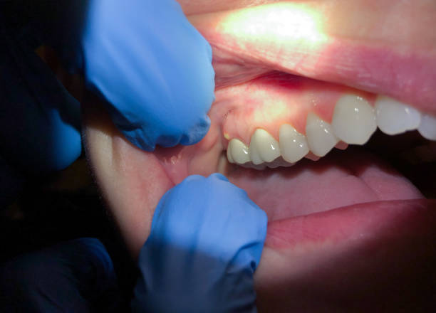 Best Emergency Treatment for Dental Infections or Abscesses in Mauldin, SC