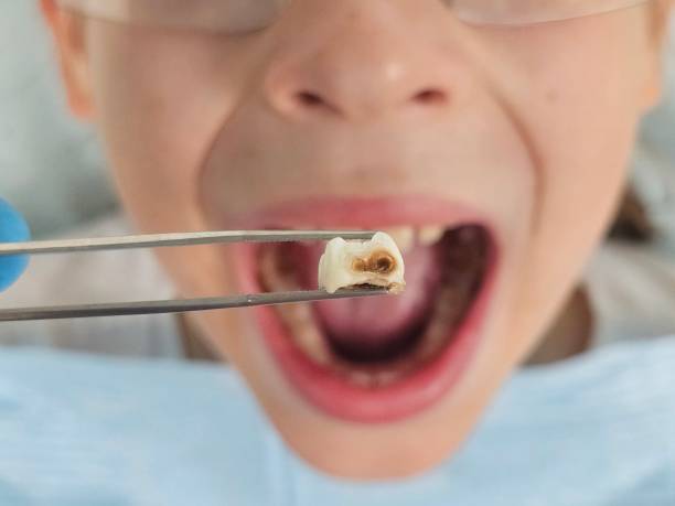 Best Emergency Gum Treatment in Mauldin, SC